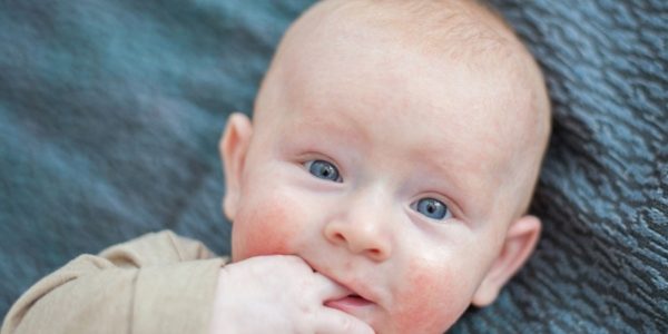 ¿Qué es el exantema súbito?