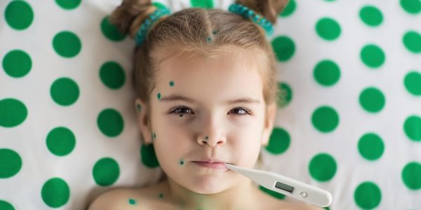 ¿Fiesta de la varicela? Qué es y cuáles son sus riesgos ¿Fiesta de la varicela? Qué es y cuáles son sus riesgos